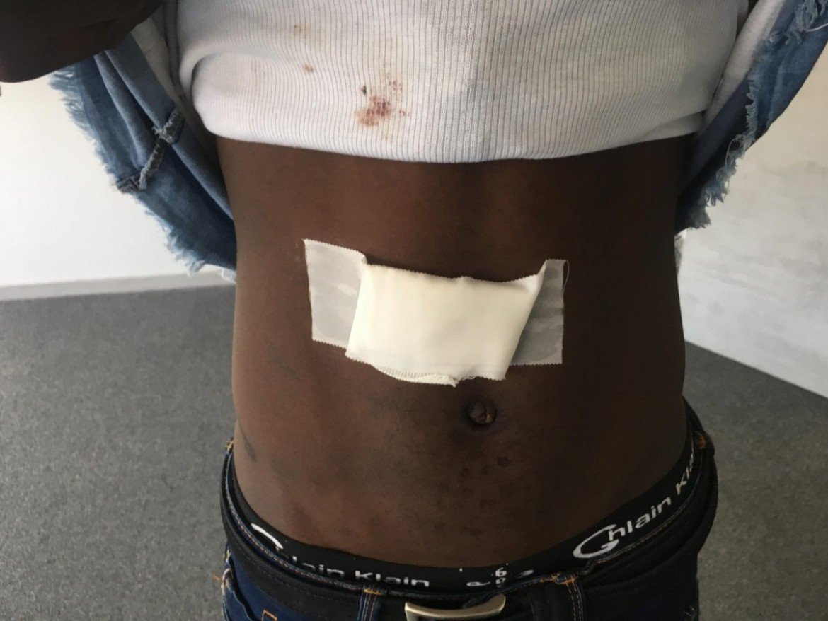 Napoli, giovane maliano ferito a colpi di fucile da caccia